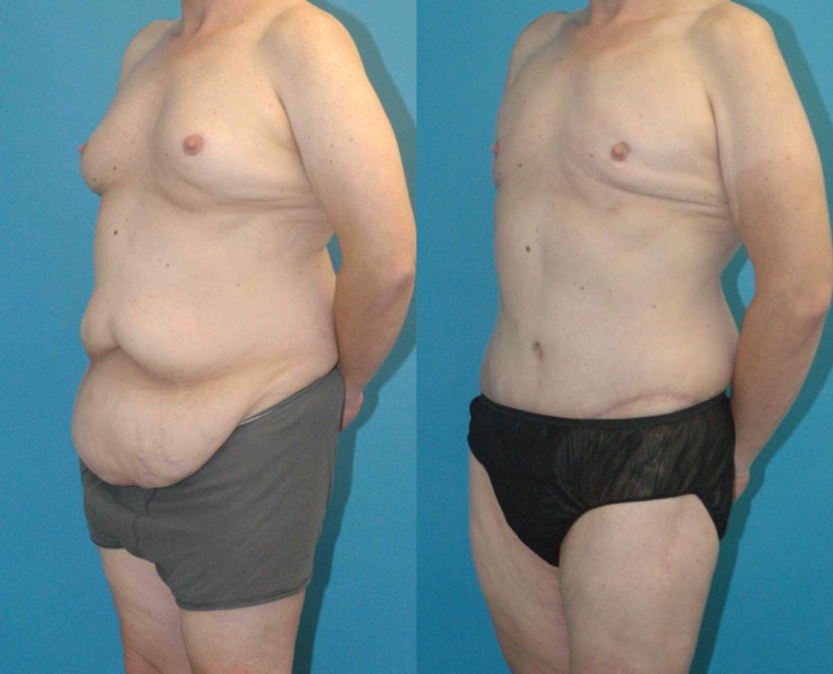 Lower Body Lift #7 - Before and After