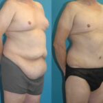 Lower Body Lift #7 - Before and After