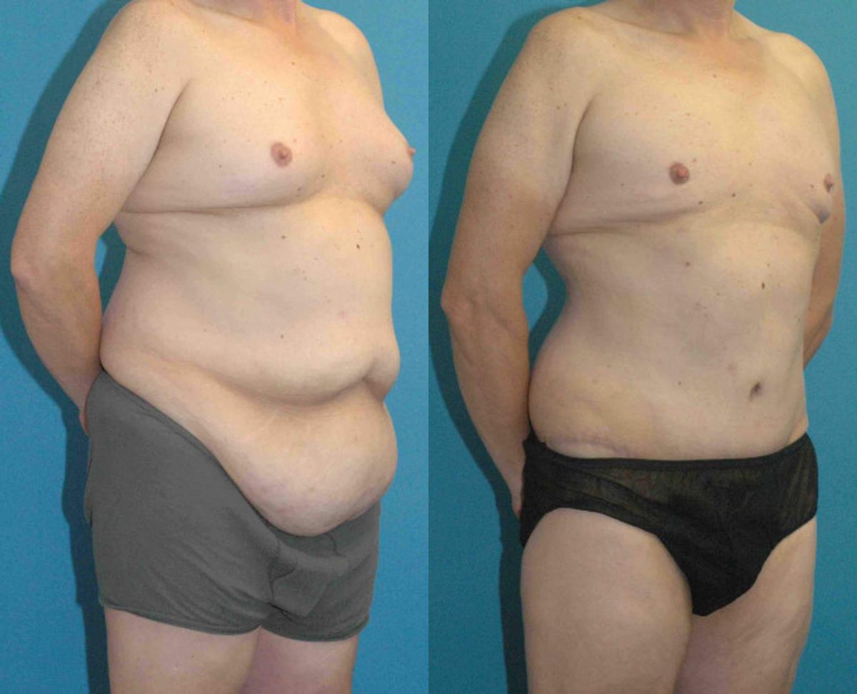 Lower Body Lift #7 - Before and After