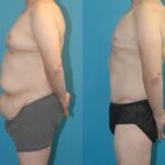 Lower Body Lift #7 - Before and After