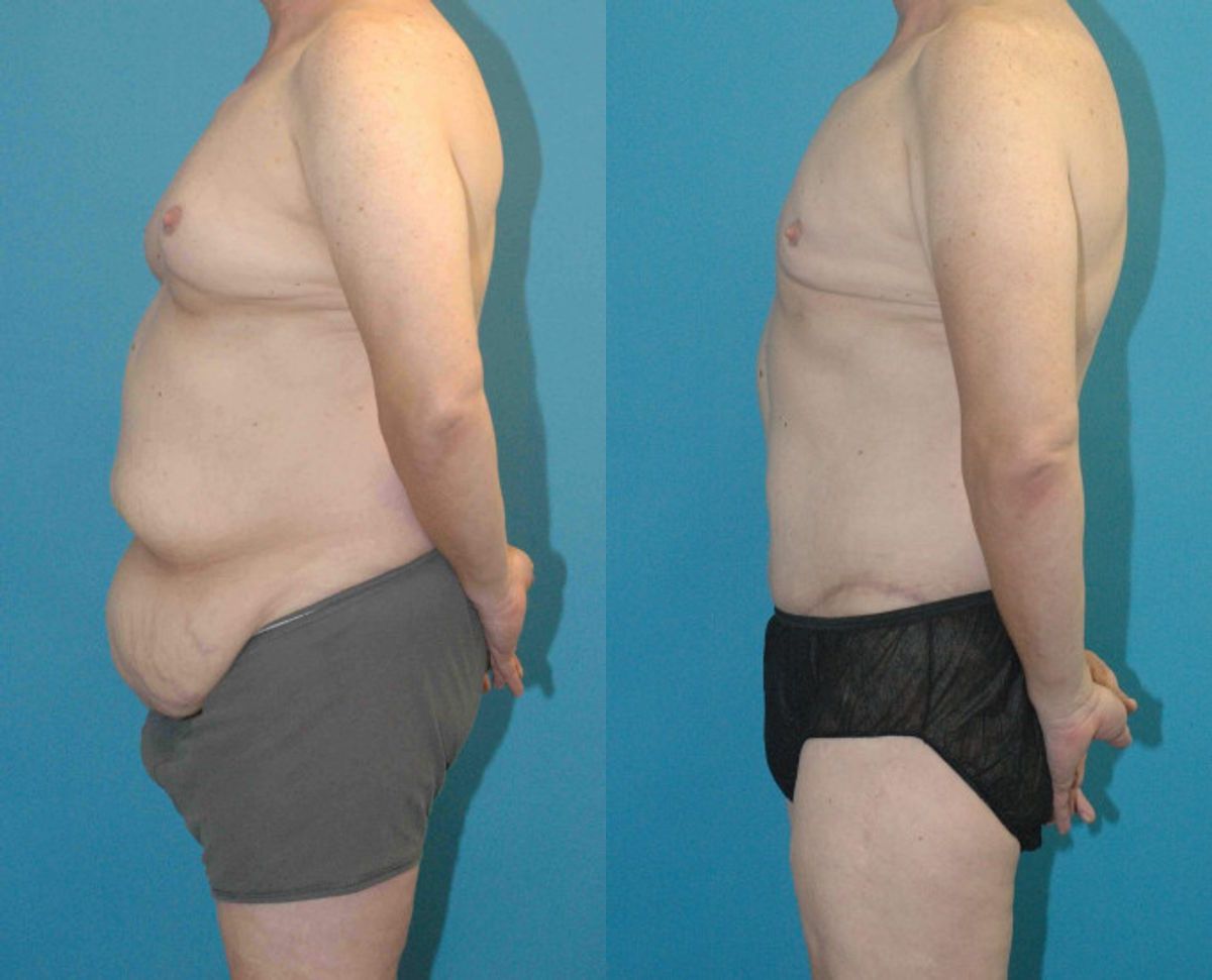 Lower Body Lift #7 - Before and After