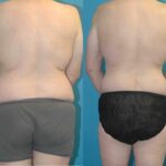 Lower Body Lift #7 - Before and After