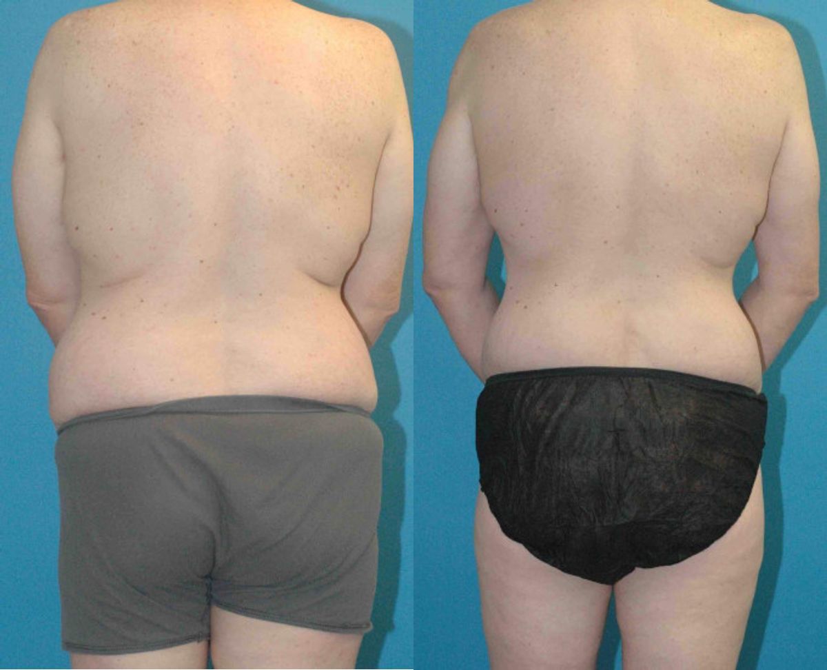 Lower Body Lift #7 - Before and After