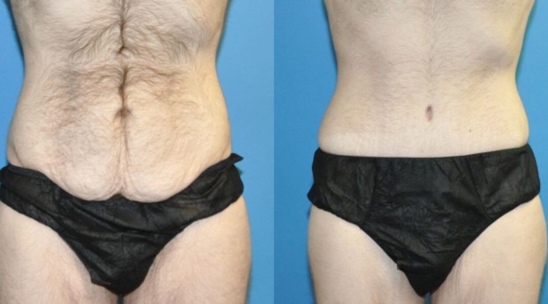Lower Body Lift #8