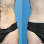 Lower Body Lift #8 - Before and After