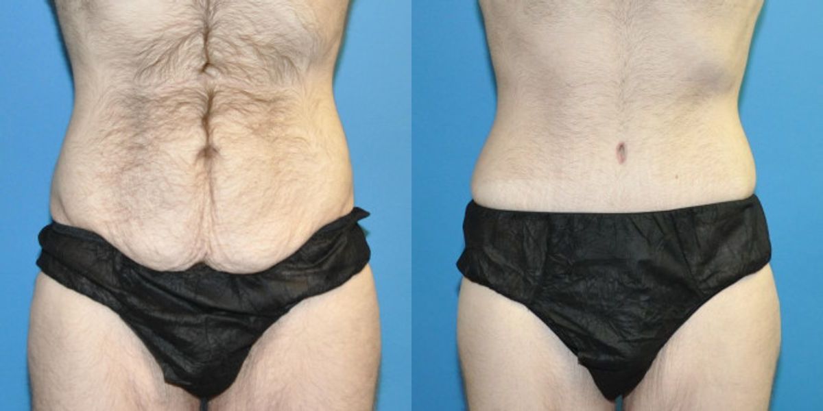 Lower Body Lift #8 - Before and After