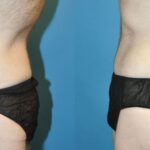 Lower Body Lift #8 - Before and After