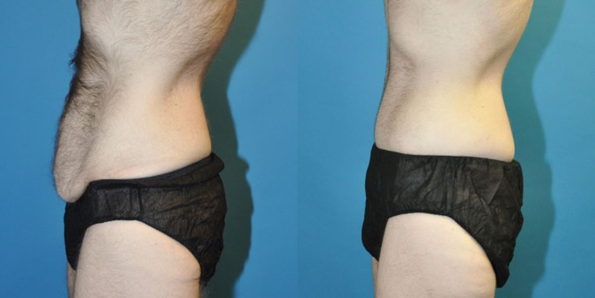 Lower Body Lift #8 - Before and After