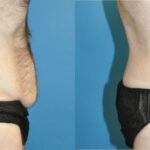 Lower Body Lift #8 - Before and After