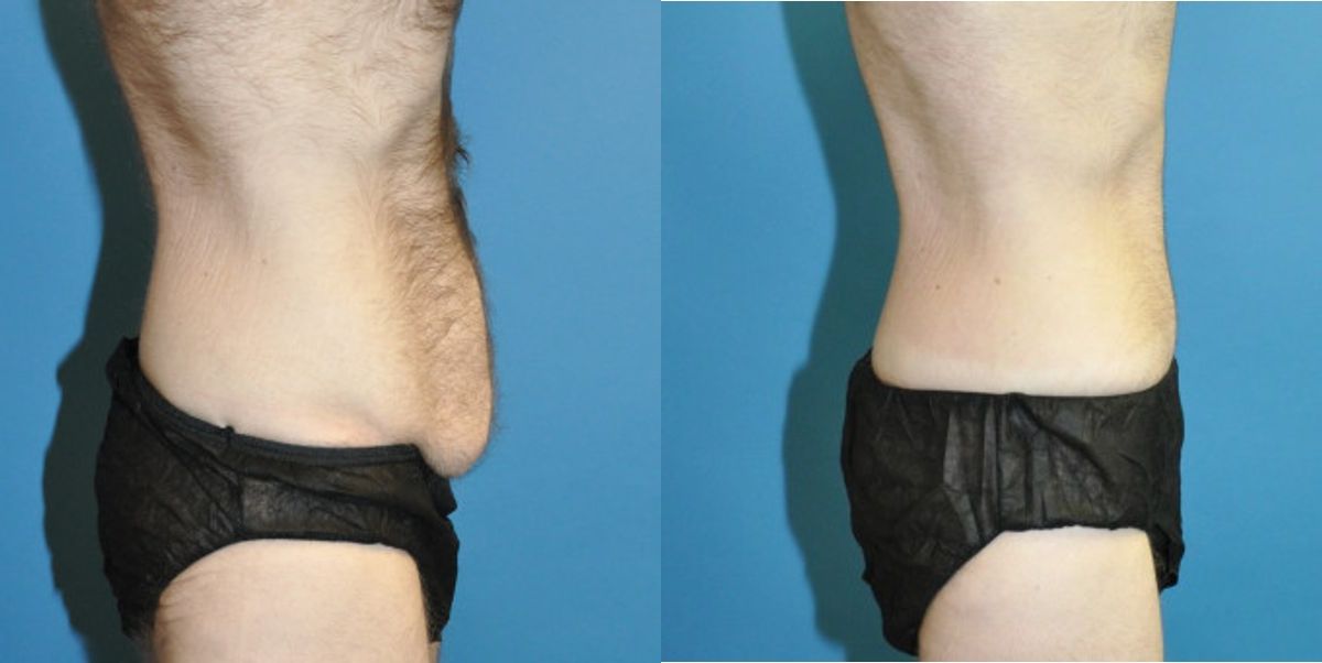Lower Body Lift #8 - Before and After