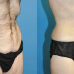 Lower Body Lift #8 - Before and After