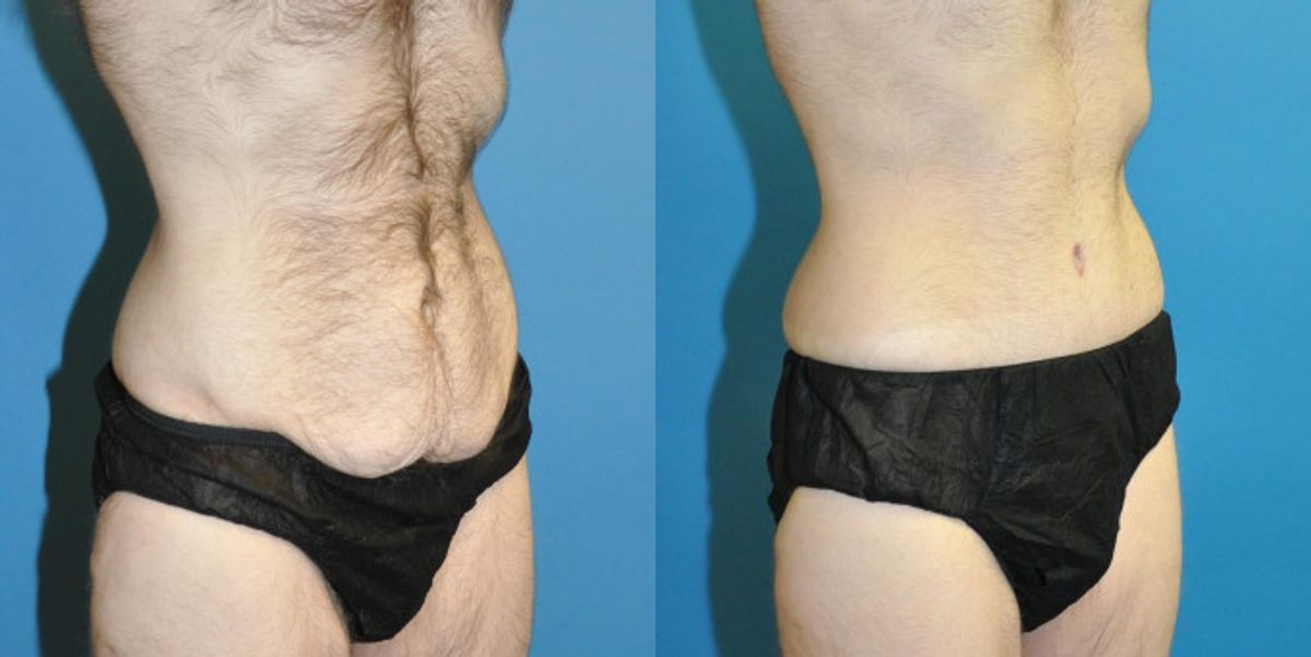 Lower Body Lift #8 - Before and After