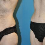 Lower Body Lift #8 - Before and After