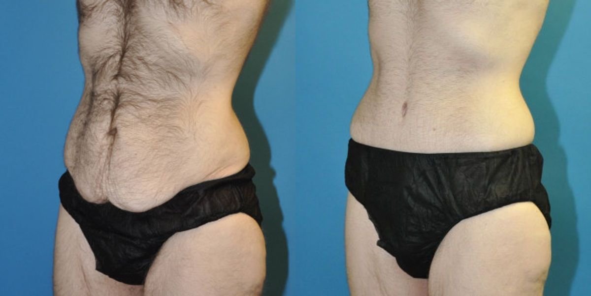 Lower Body Lift #8 - Before and After