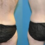 Lower Body Lift #8 - Before and After