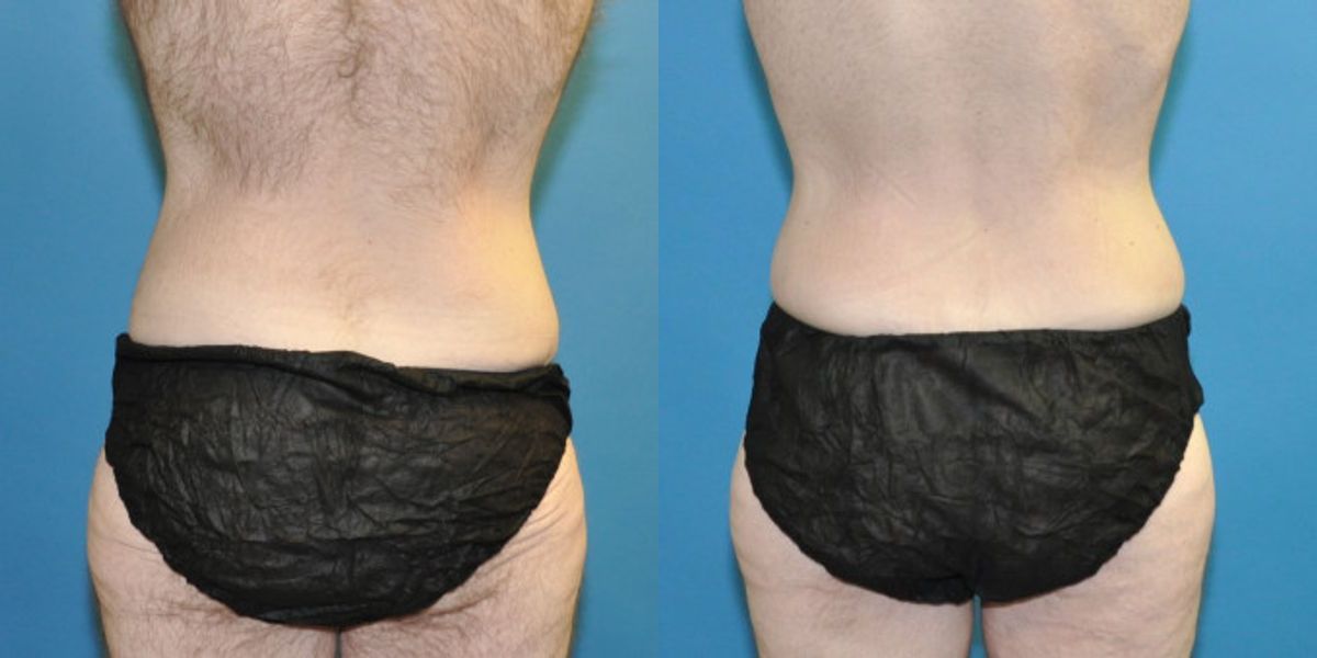 Lower Body Lift #8 - Before and After