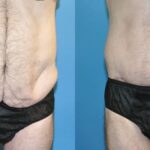 Lower Body Lift #9 - Before and After