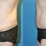 Lower Body Lift #9 - Before and After