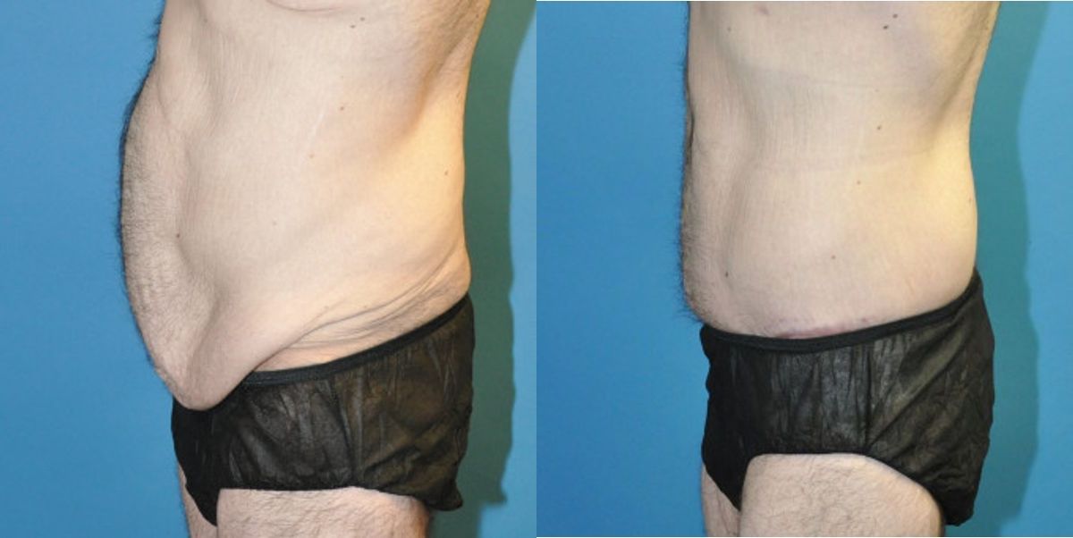 Lower Body Lift #9 - Before and After