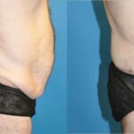 Lower Body Lift #9 - Before and After