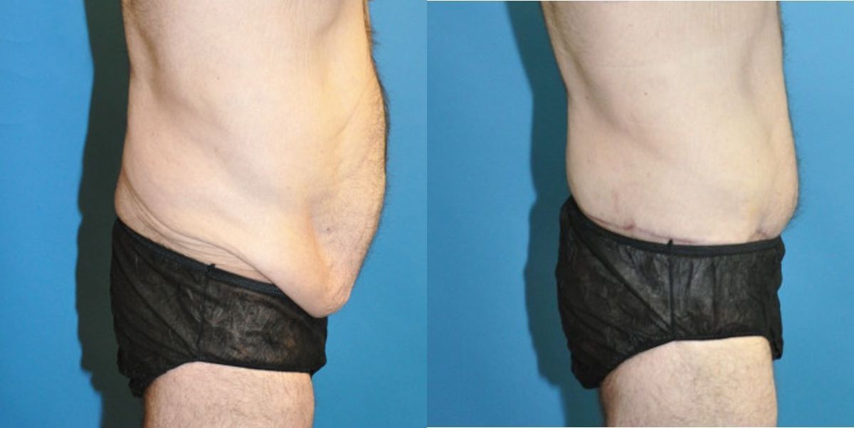 Lower Body Lift #9 - Before and After