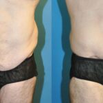 Lower Body Lift #9 - Before and After