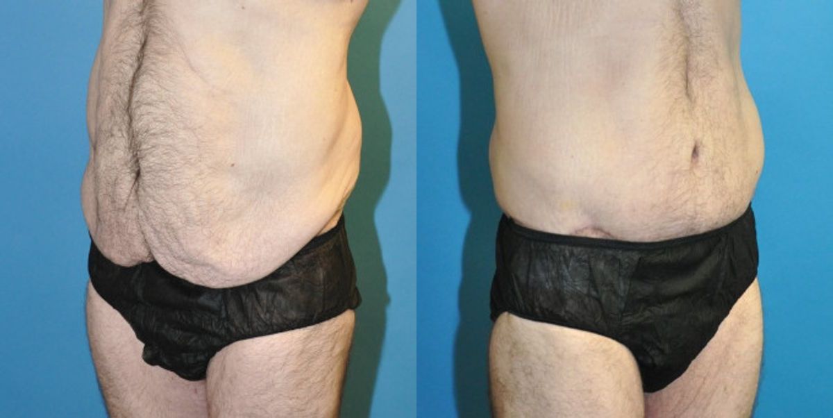 Lower Body Lift #9 - Before and After