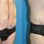 Lower Body Lift #9 - Before and After
