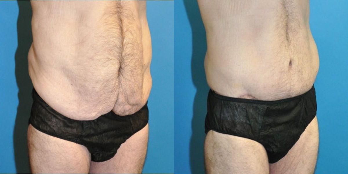 Lower Body Lift #9 - Before and After