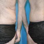 Lower Body Lift #9 - Before and After