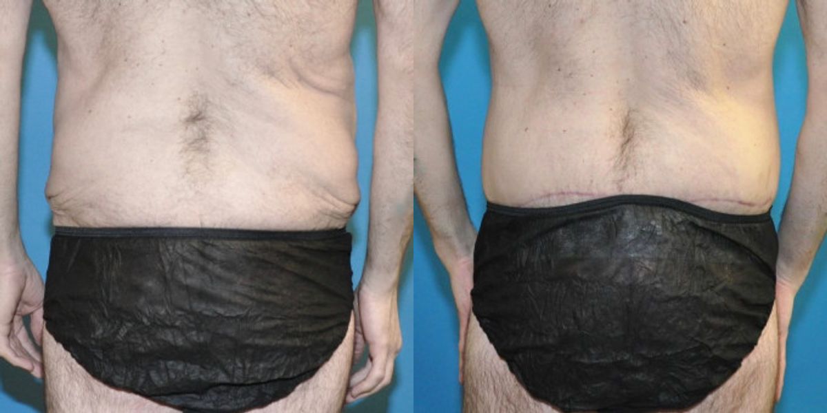 Lower Body Lift #9 - Before and After