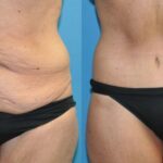 Lower Body Lift #12 - Before and After