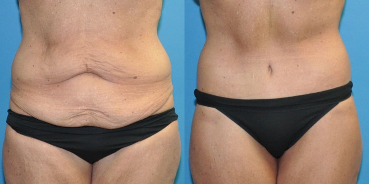 Lower Body Lift #12 - Before and After