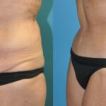 Lower Body Lift #12 - Before and After