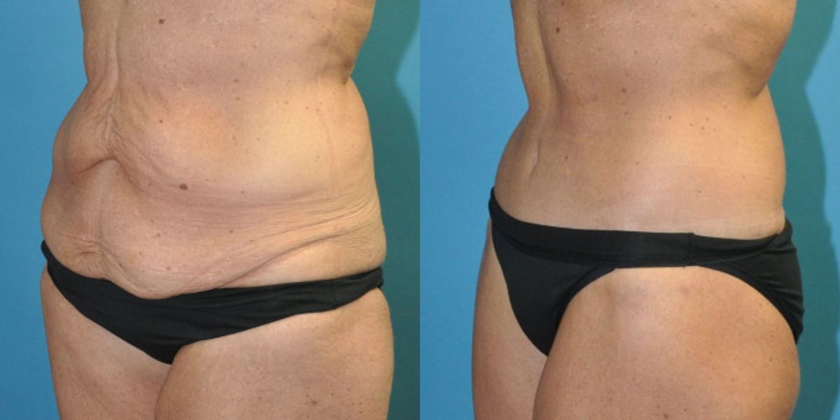 Lower Body Lift #12 - Before and After