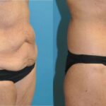 Lower Body Lift #12 - Before and After