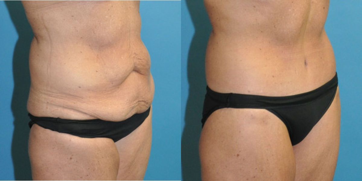 Lower Body Lift #12 - Before and After