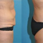 Lower Body Lift #12 - Before and After