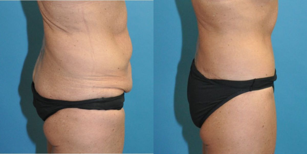 Lower Body Lift #12 - Before and After