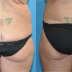 Lower Body Lift #12 - Before and After