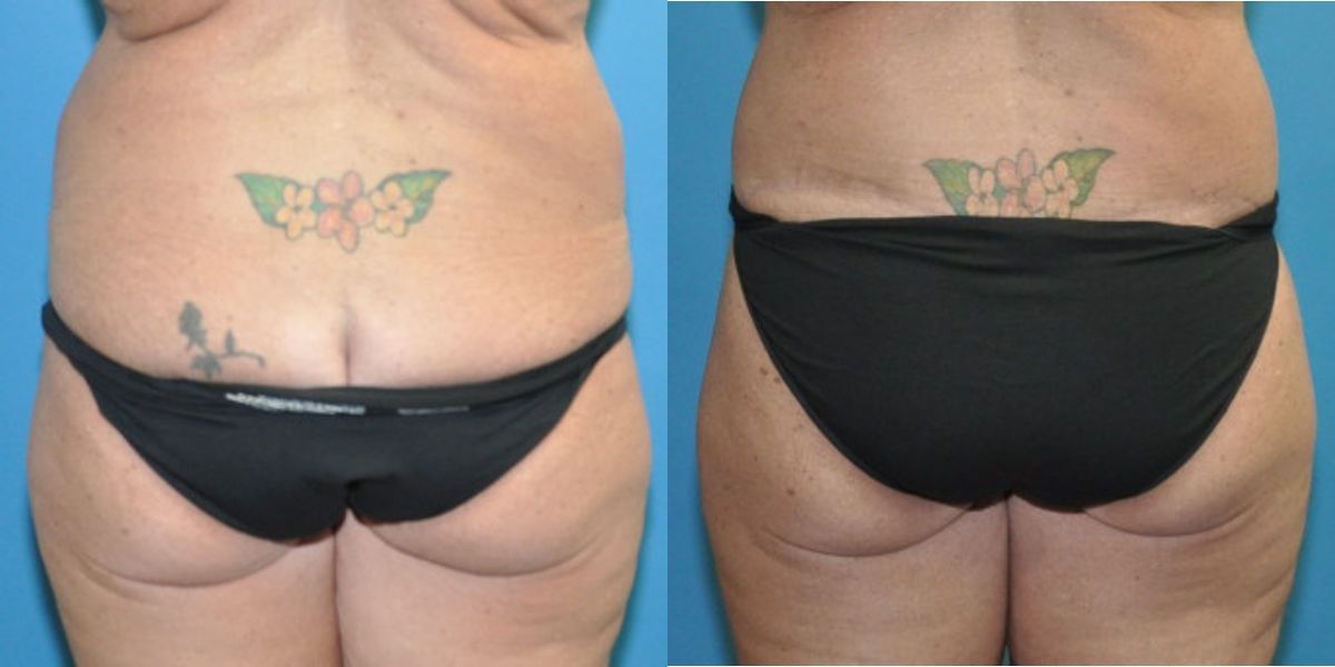 Lower Body Lift #12 - Before and After
