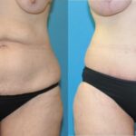 Lower Body Lift #13 - Before and After
