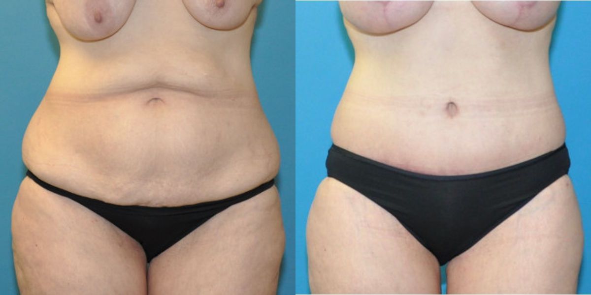 Lower Body Lift #13 - Before and After