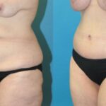 Lower Body Lift #13 - Before and After