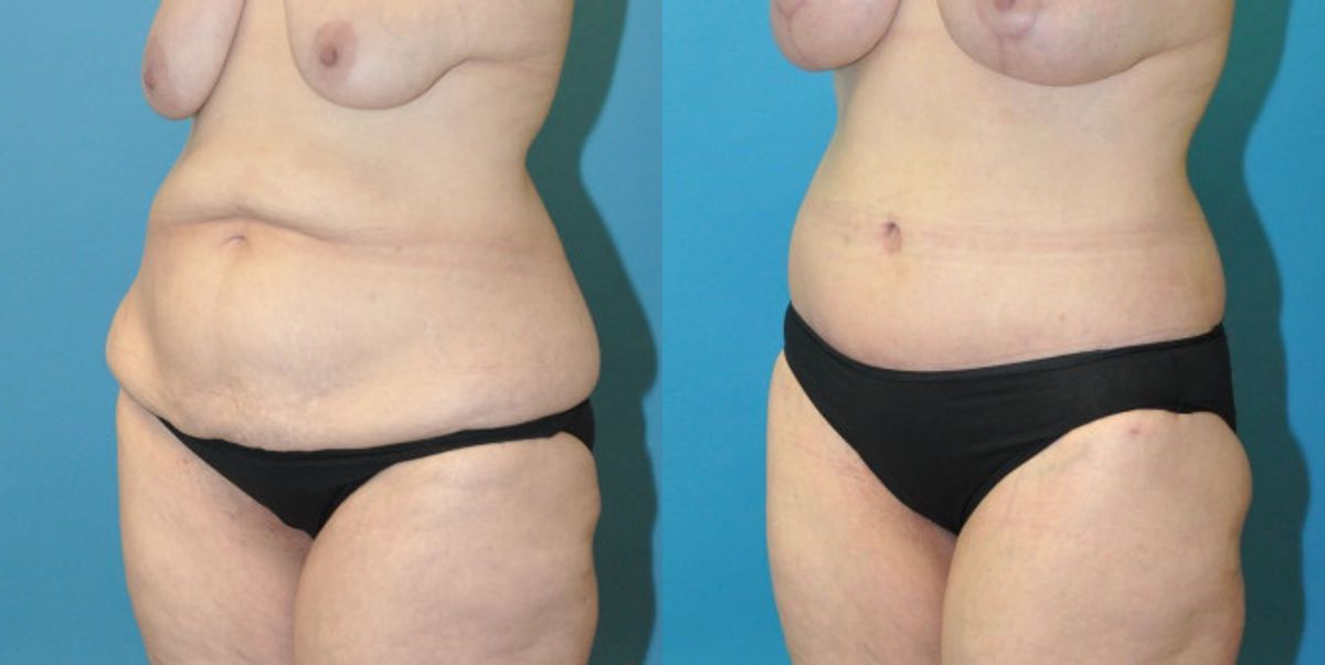 Lower Body Lift #13 - Before and After