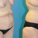 Lower Body Lift #13 - Before and After