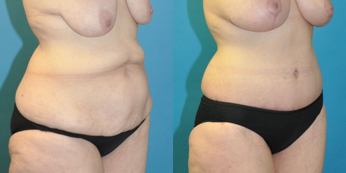 Lower Body Lift #13 - Before and After