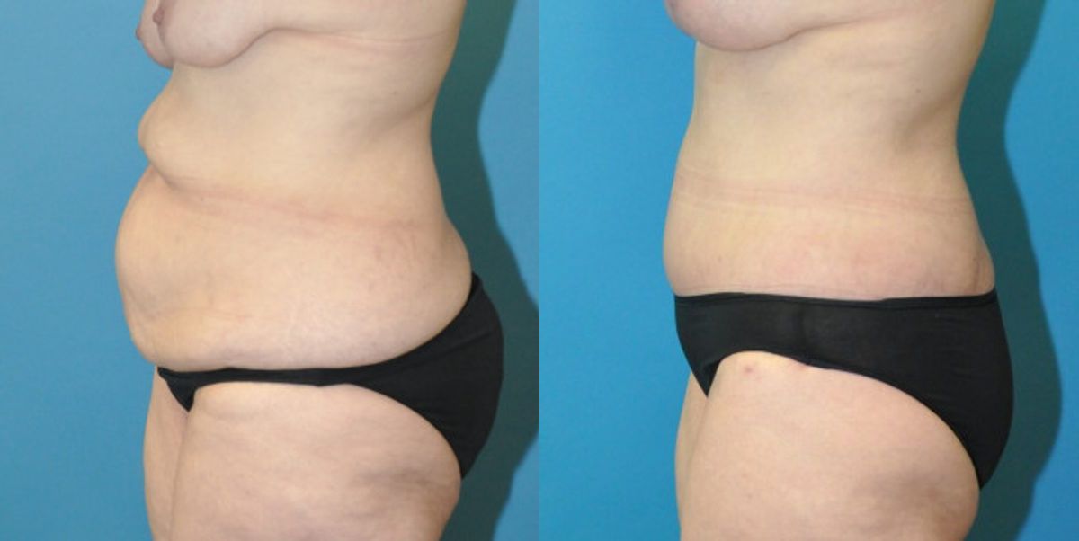 Lower Body Lift #13 - Before and After