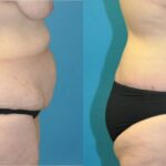 Lower Body Lift #13 - Before and After