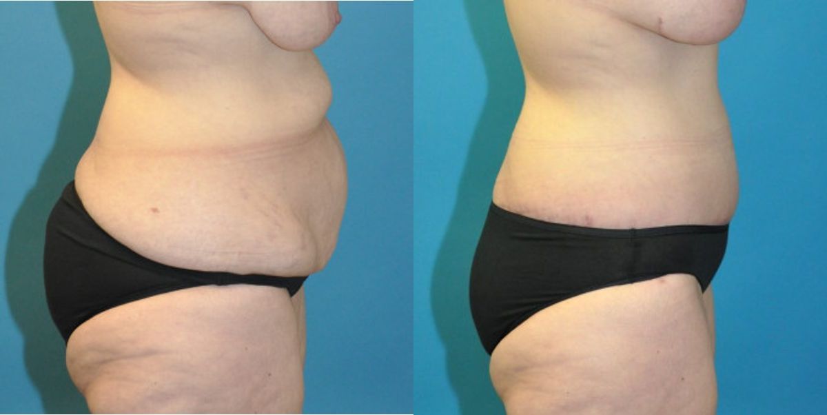 Lower Body Lift #13 - Before and After